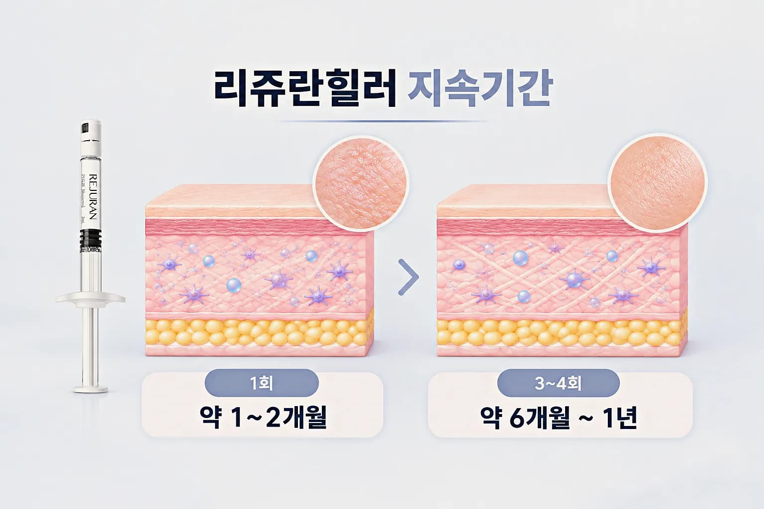 리쥬란힐러 지속기간 - 1회와 3~4회 주기 완료의 차이