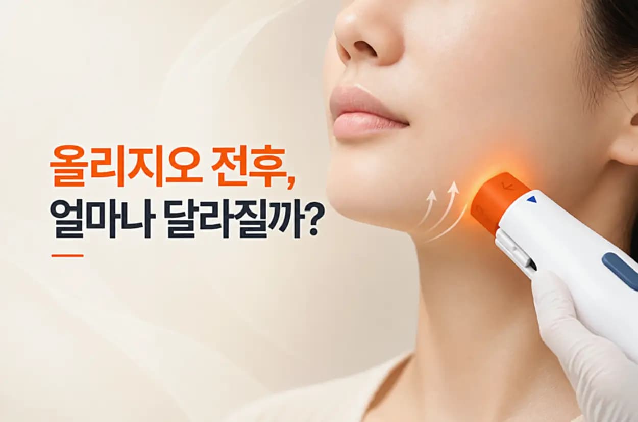 고주파 핸드피스 팁이 볼 피부에 닿아 진피 콜라겐에 열이 전달되는 올리지오 전후 썸네일