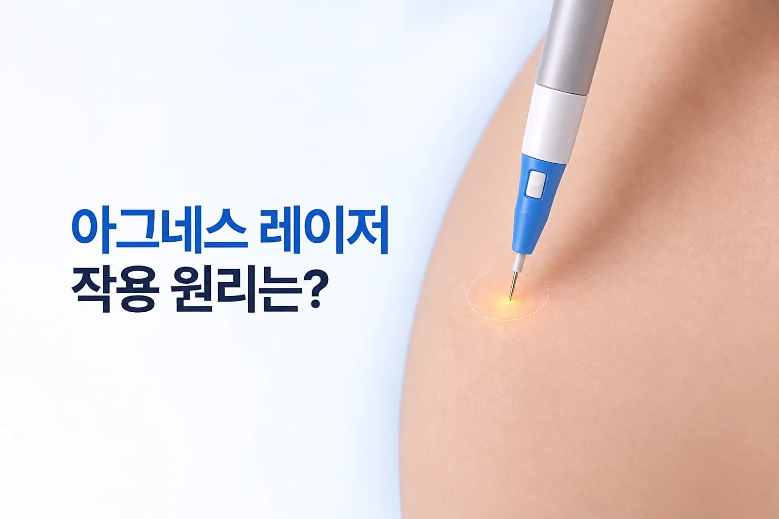 절연 미세침 핸드피스가 피지선에 고주파 열을 전달하는 아그네스 레이저 원리 썸네일